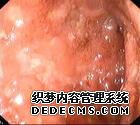 结肠炎是怎么回事
